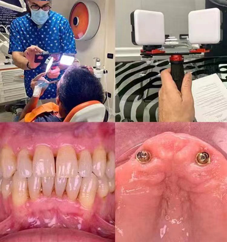 Dental intraoral photography mobile phone fill light portable