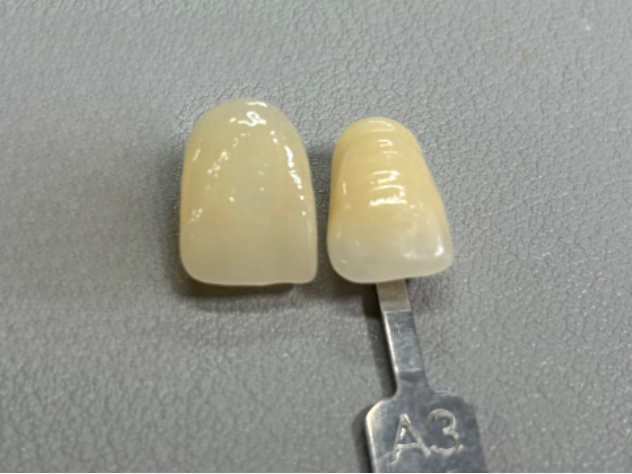 VASDEN Dental Multilayer Glass Ceramic C14 Aesthetic Veneer CADCAM Material