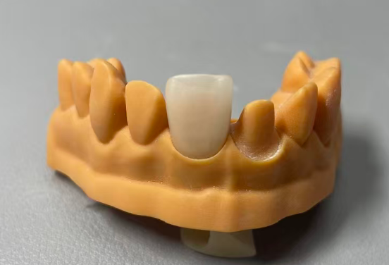 VASDEN Dental Multilayer Glass Ceramic C14 Aesthetic Veneer CADCAM Material
